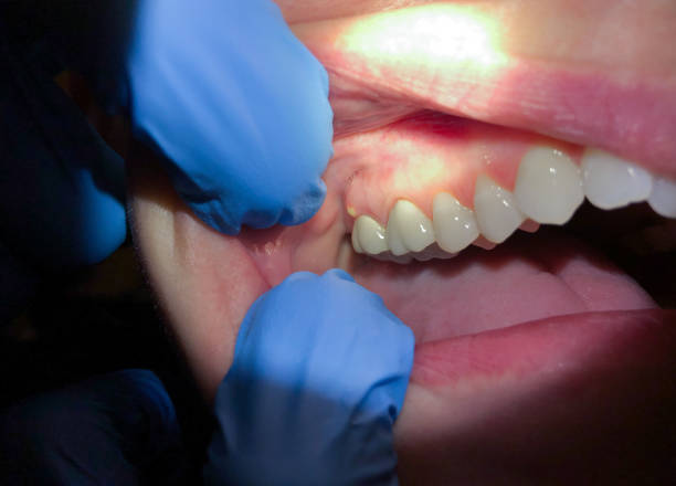 Best Emergency Root Canal Treatment in Oak Grove, SC