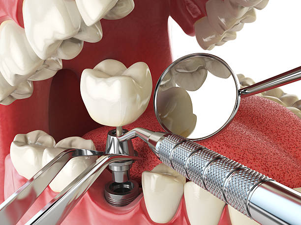 Best Emergency Dentist for Knocked-Out Tooth in Oak Grove, SC